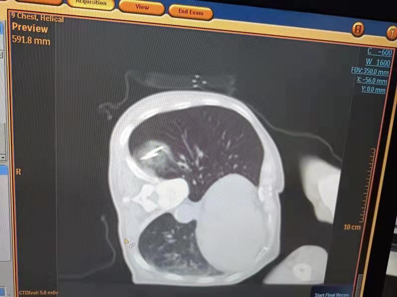 甲状腺结节消融术病例分析,肺部结节冷冻消融