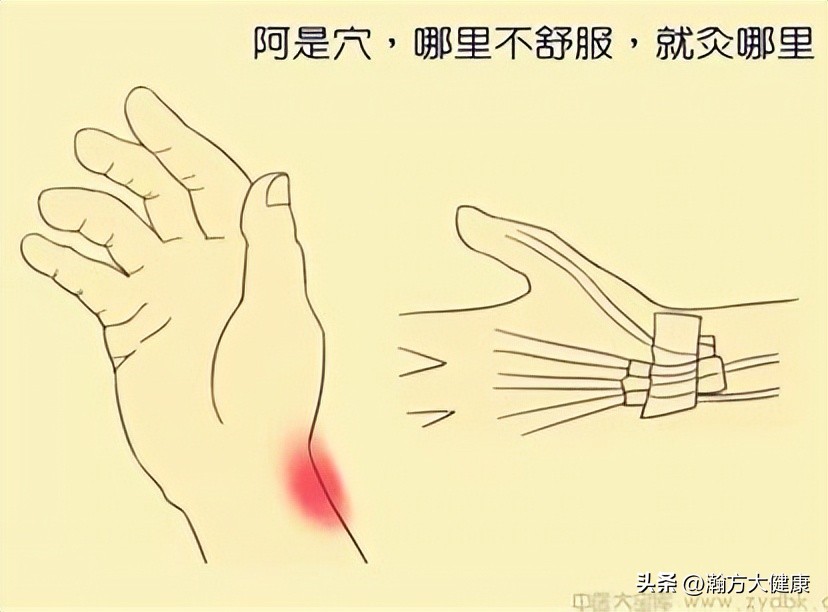 中草药治疗疤痕疙瘩良方,疤痕体质用什么方式祛黑痣