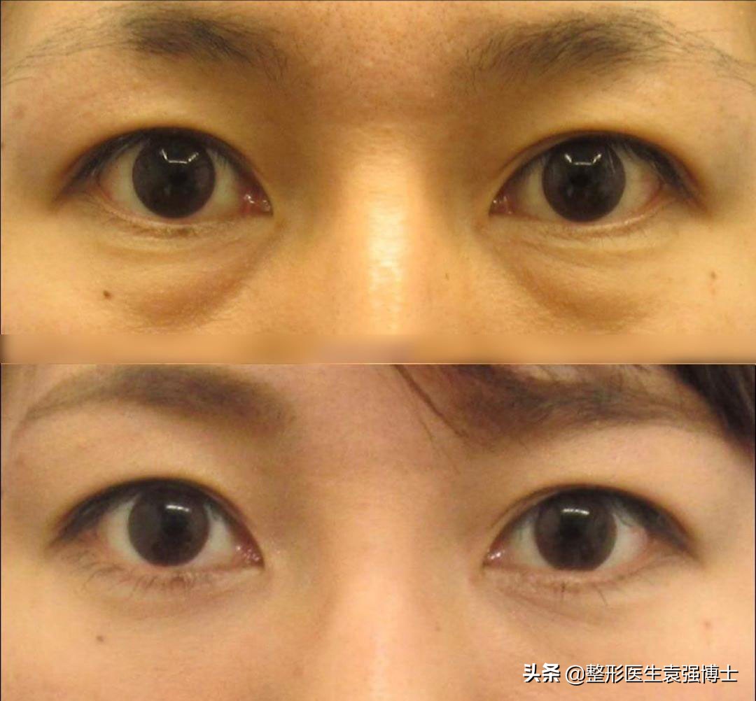 祛眼袋手术的真相,眼袋去除手术真实案例