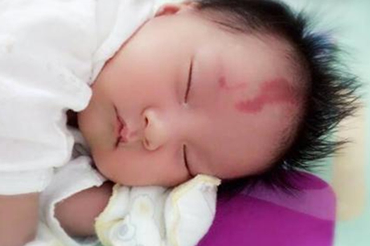 婴儿黑色胎记对孩子有什么影响,长胎记跟孕妇饮食有关吗