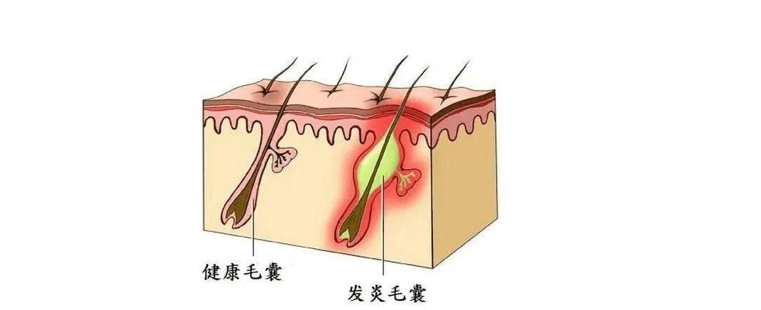阴部尴尬的瘙痒，可能是阴虱在作怪，警惕阴虱的这3个传播途径