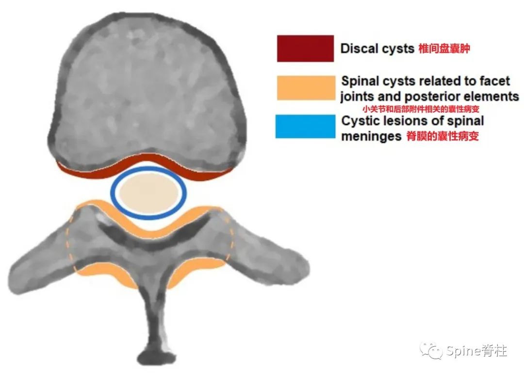腰椎椎管有囊性结构,水平椎管内囊性占位
