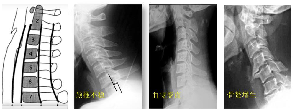 颈痛的最佳治疗方法,最近肩颈疼是什么病毒