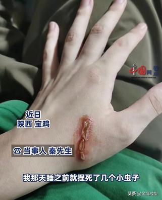 紧迫的！陕西被发现了！男子皮肤多处溃烂，5天仍未愈合