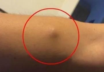 身体上长了脂肪瘤怎么办？需要处理吗？