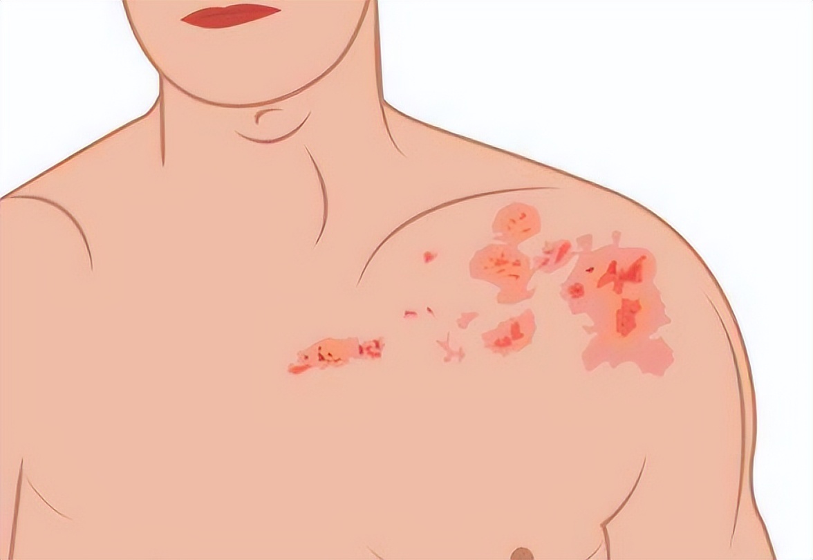 手上脚上起小水泡很痒是怎么回事,脚上起水泡很痒怎么治用什么膏药