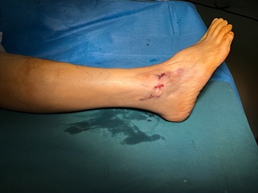 踝关节韧带重建后的最佳锻炼方法,冉冉跟腱康复