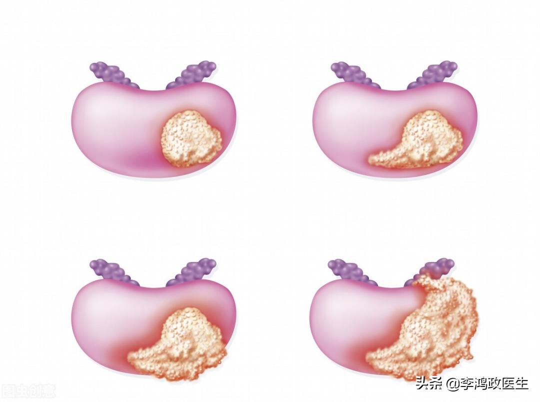 什么体检项目是筛查癌症最好方法,女性癌症筛查体检项目几年一次