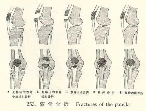 髌骨骨折的临床症状有哪些,髌骨骨折病因及发病机制