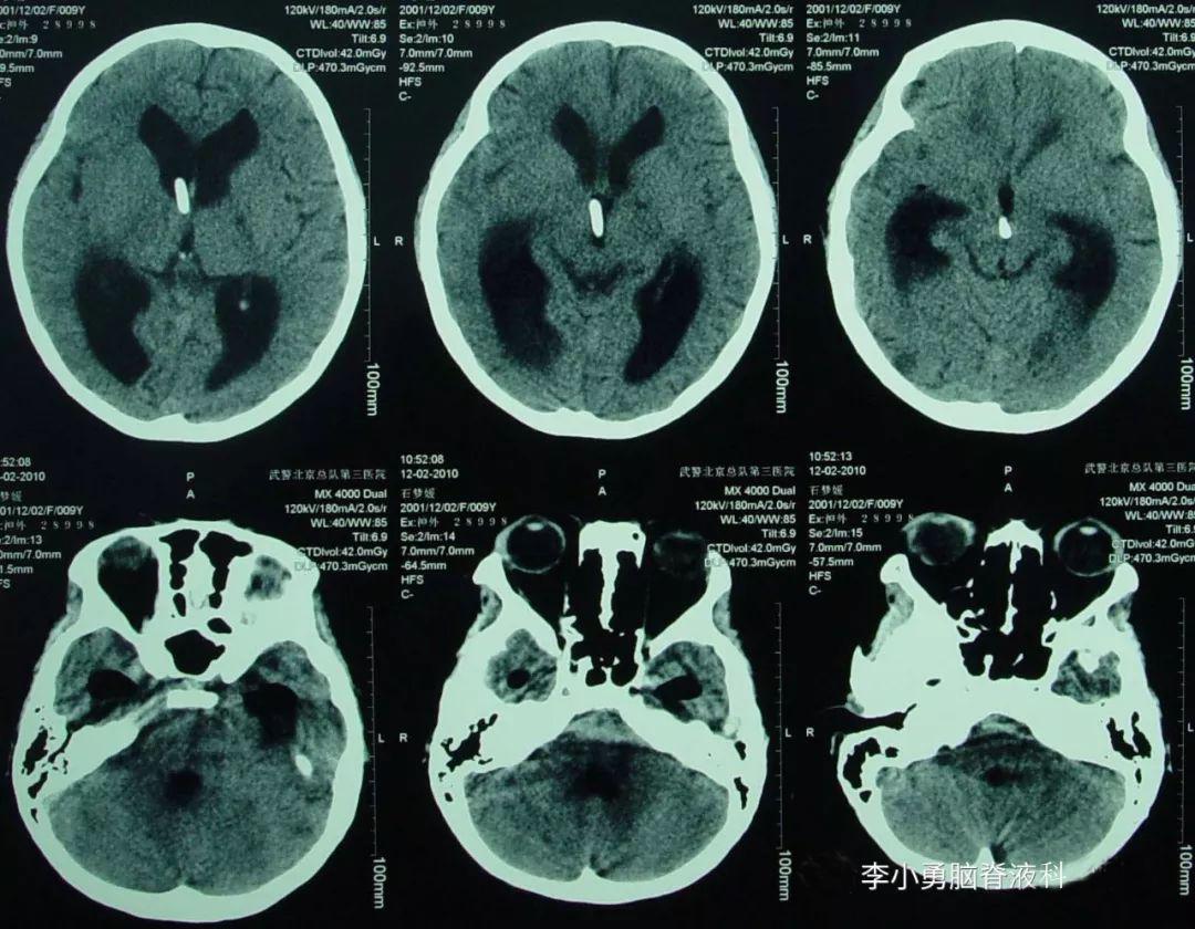 儿童结核脑膜炎脑积水,结核性脑膜炎脑积水如何引起