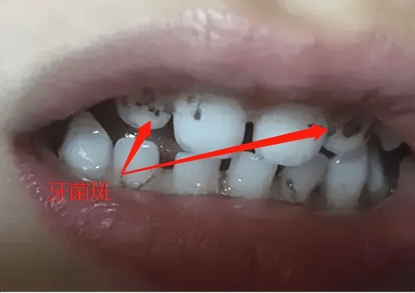 美白牙粉的功效和作用,牙齿美白去黄牙粉使用方法