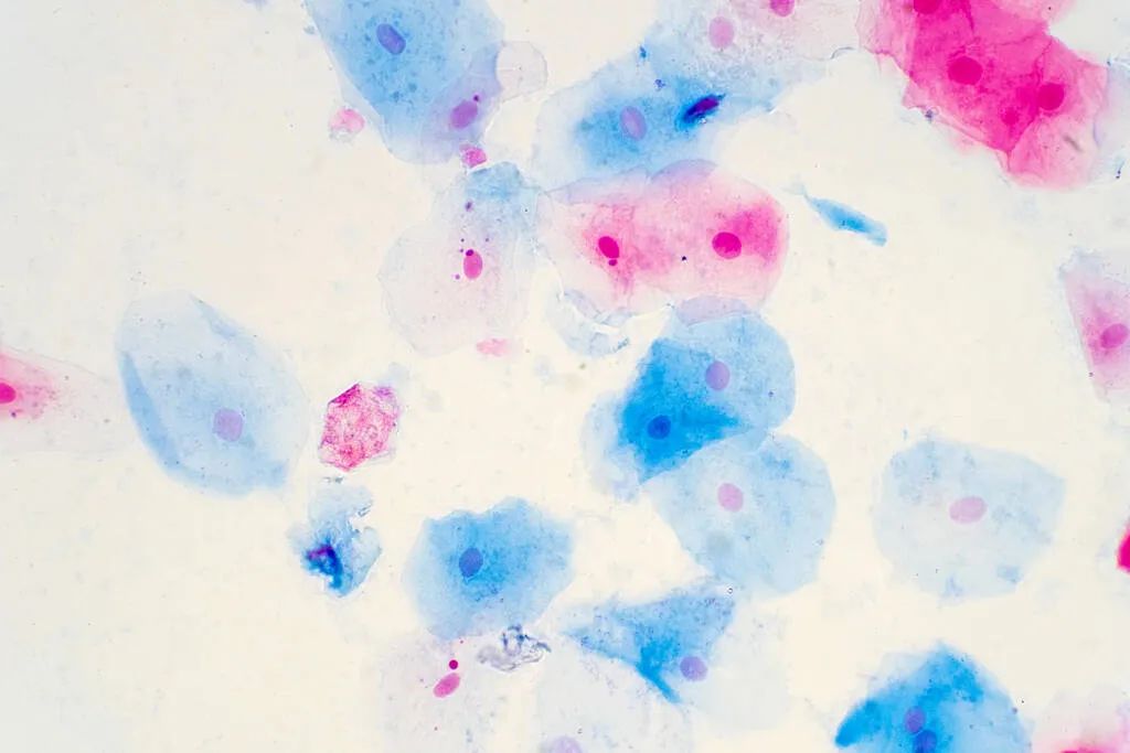 女性hpv高危型病毒16能自愈吗,女性一生中感染hpv的几率达80%