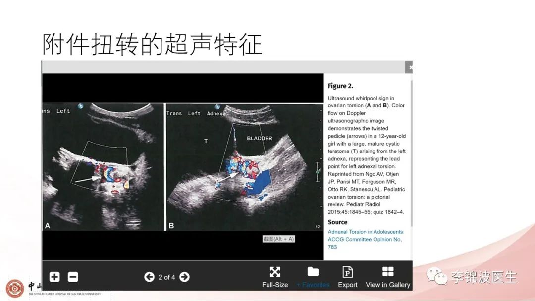 附睾炎附件扭转严重吗,附睾头附近的附件扭转