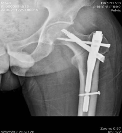 烟台海港医院用新技术PFBN助力，治疗股骨粗隆间骨折