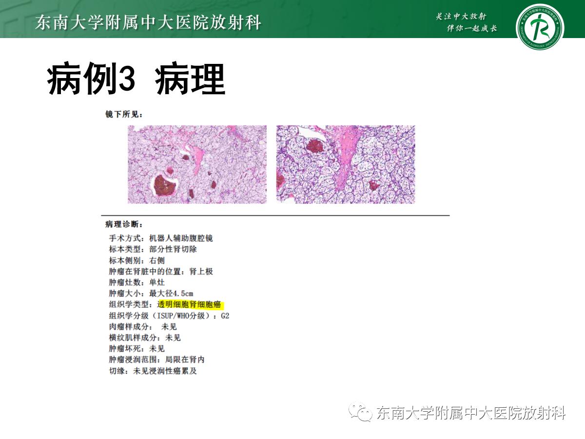 周利群谈肾嫌色细胞癌ct特点,好文分享值得深思