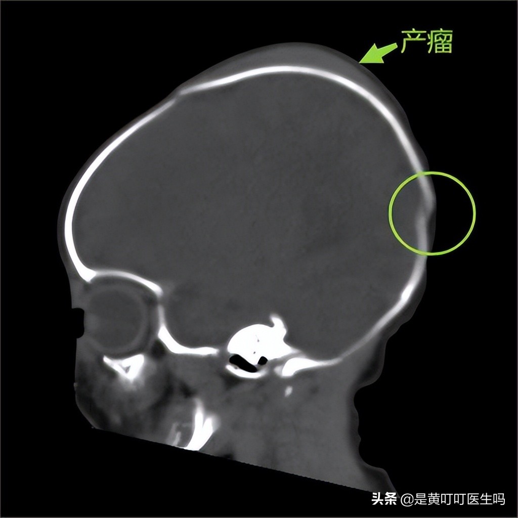 婴儿头部畸形一边大一边小,宝宝刚出生时头顶肿了一个大包