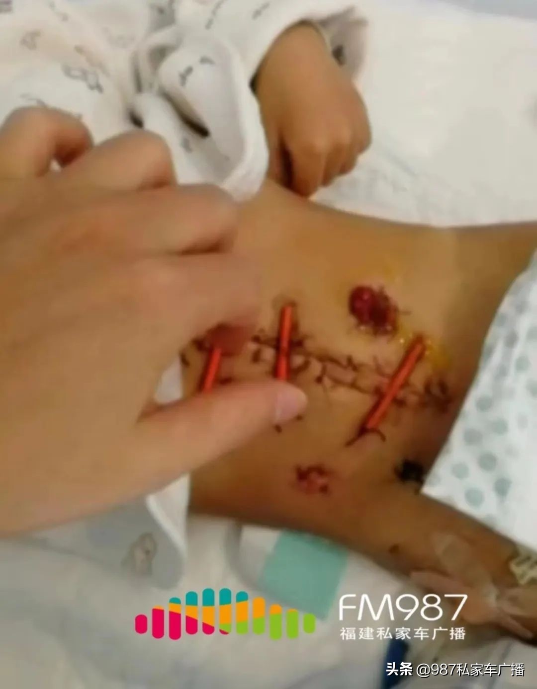 2岁孩子骨瘦如柴！福建黄先生多次签病危通知书