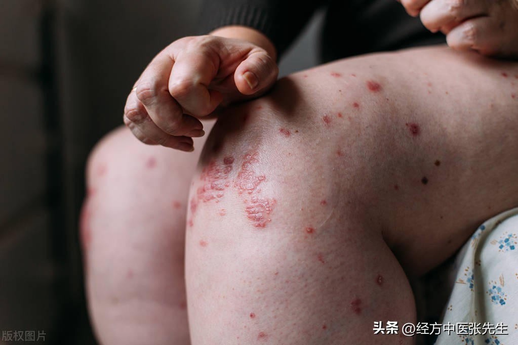 十多年湿疹顽固患者中医治愈,经验方一次断根治愈湿疹