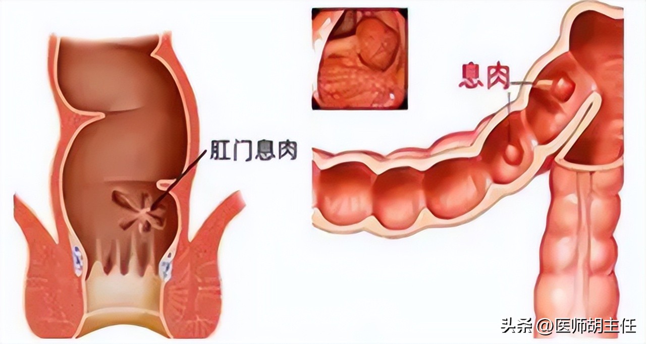 为什么肠道会长息肉,为什么肠道容易长息肉