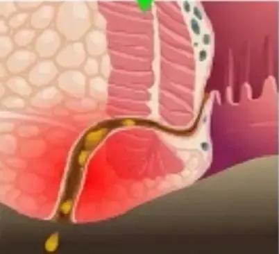肛门疼有炎症吃什么药,肛门脓肿太疼吃什么药