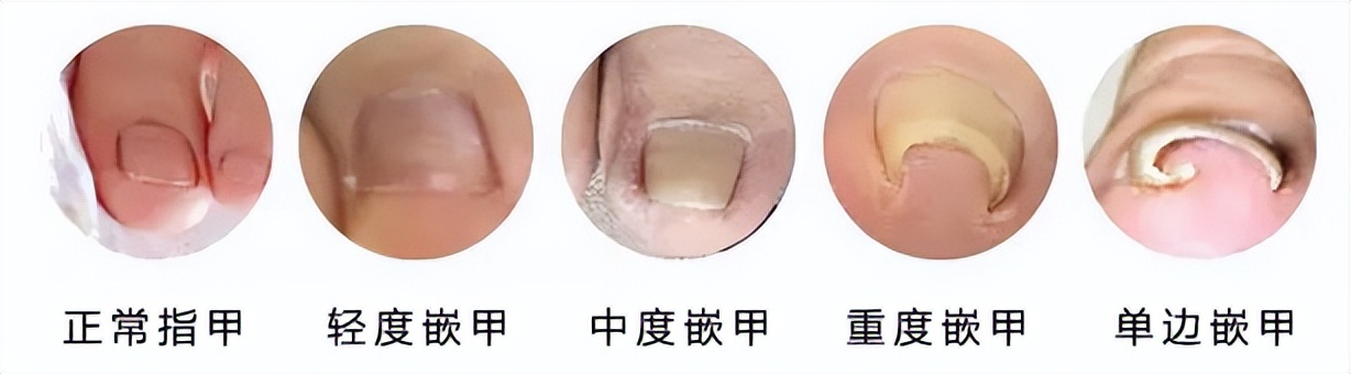 一走路脚指甲里疼怎么回事,一走路脚趾骨疼痛是什么原因呢