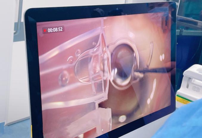 一术多效！首批全新一代散光矫正型白内障手术在爱尔眼科成功开展