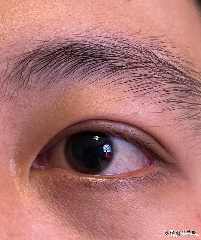 以色列近视手术多少钱,埃及做近视手术便宜吗