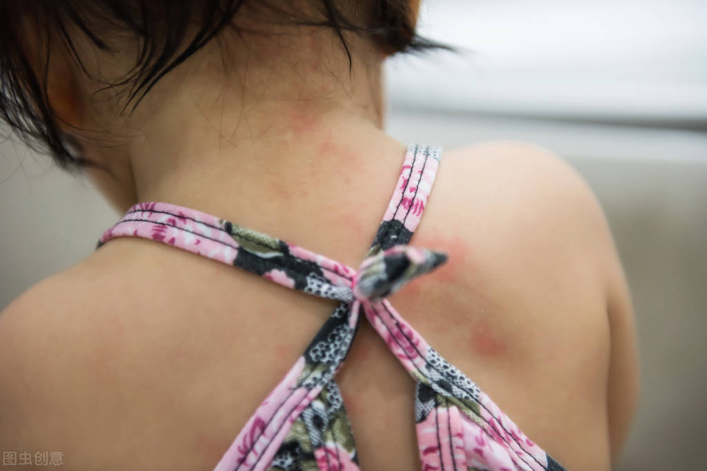 炉甘石怎么用止痒效果最好,炉甘石都有哪些剂型