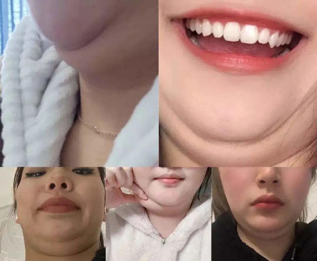 改善双下巴应该做什么医美项目,双下巴怎么改善最有效