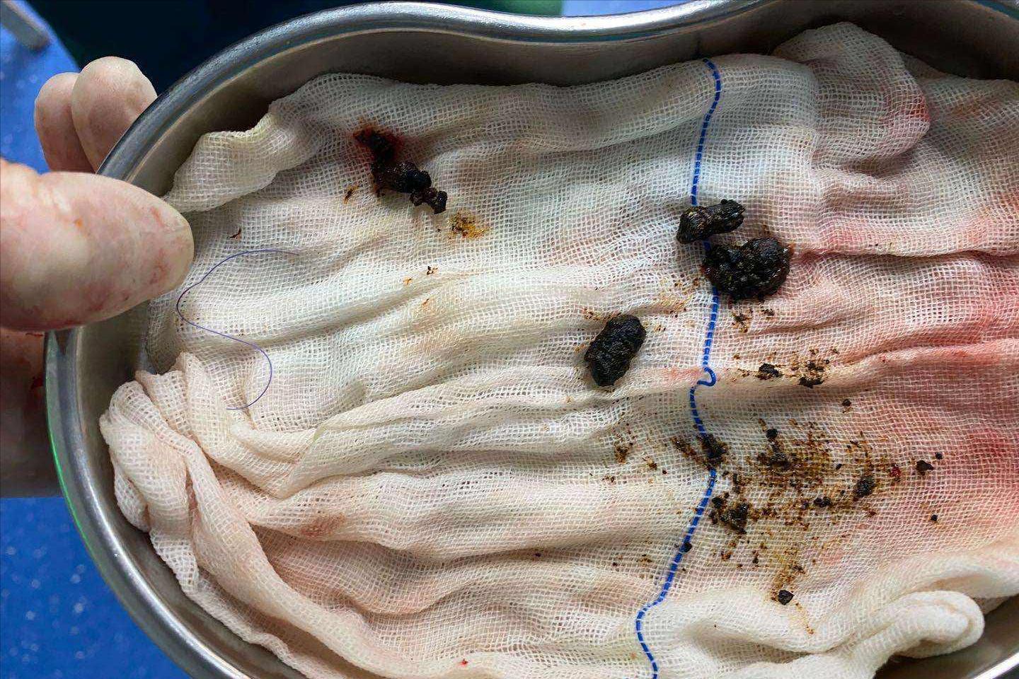 腹腔镜下胆总管切开取石治疗,充填型胆囊结石用腹腔镜怎样切除