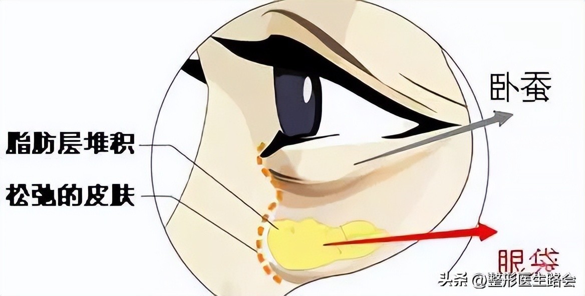 眼袋和卧蚕的区别看完你就知,怎么分清眼袋和卧蚕的区别图片
