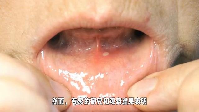 专家介绍复发口腔溃疡治疗,医生说口腔溃疡根本原因是缺血