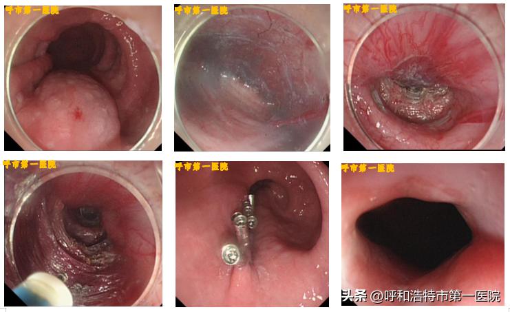 消化内科与消化内镜微创手术,贲门失弛缓症消化内科手术全过程