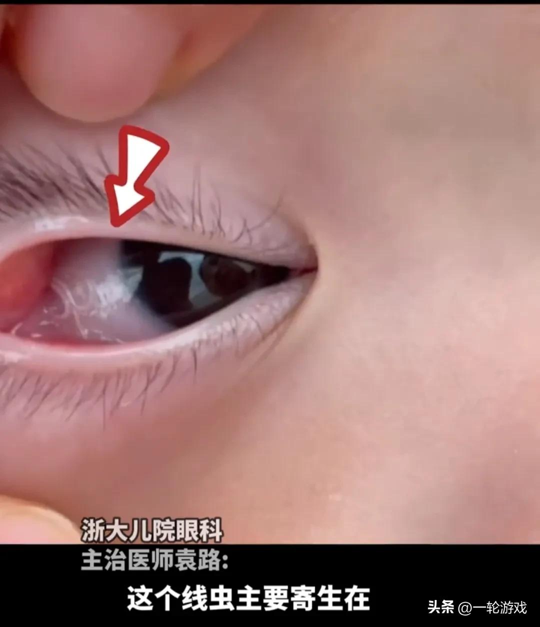 八个月大婴儿眼睛取出虫,八个月婴儿眼睛里面寄生虫后续