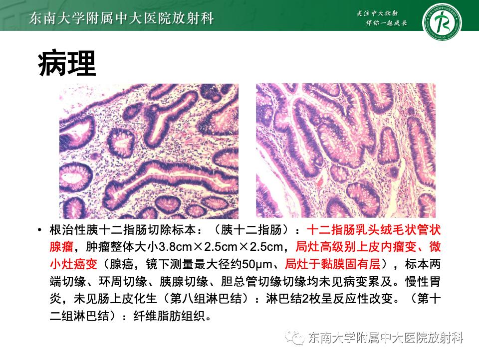 小肠间质瘤最新治疗中药方,小肠间质瘤基因检测