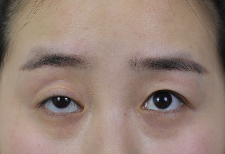 眼睛整形的真相,眼部整形对双眼皮有什么影响