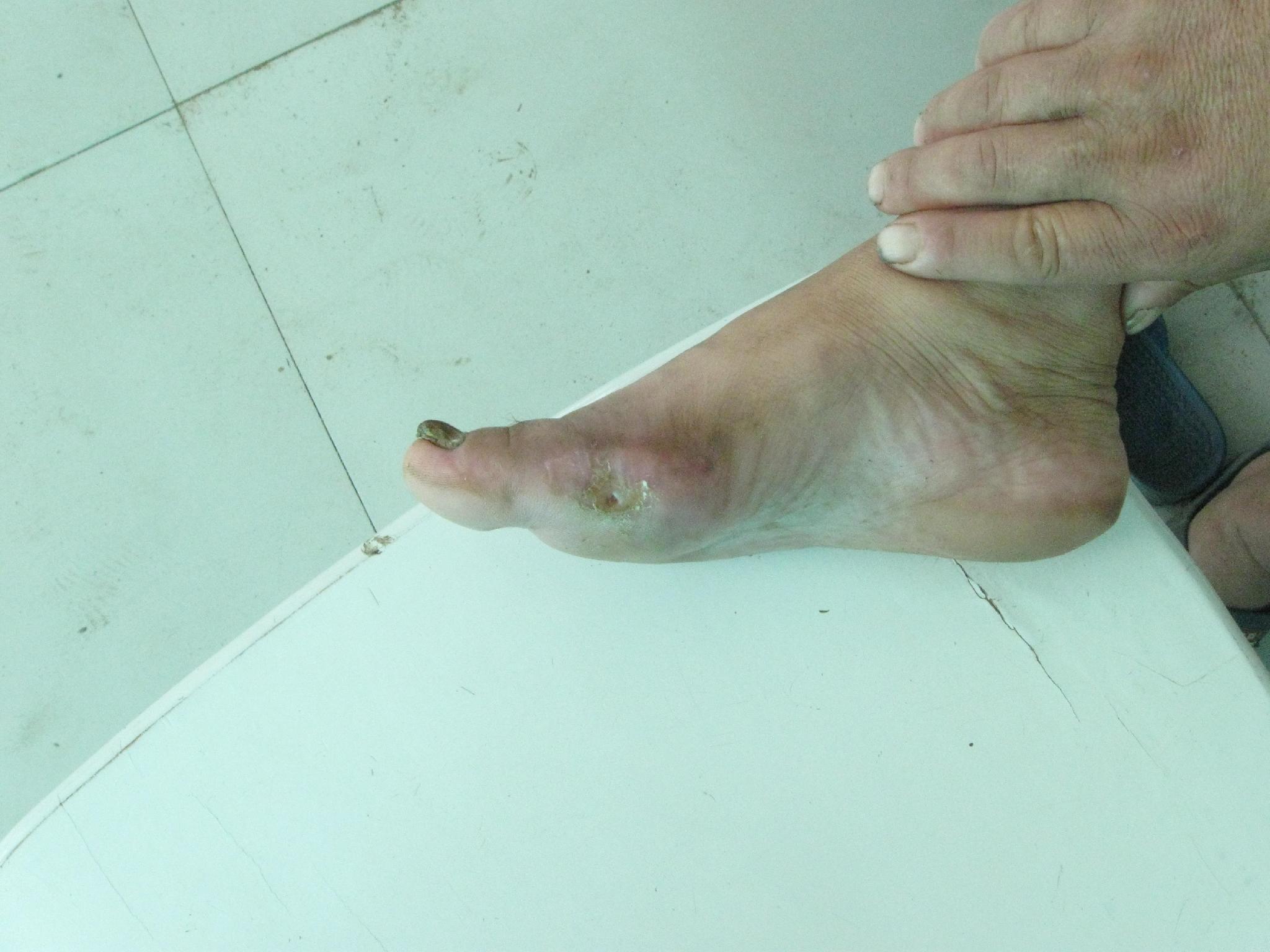 足球运动员王若吉感染新冠后去世，医生：糖尿病是致死关键因素！