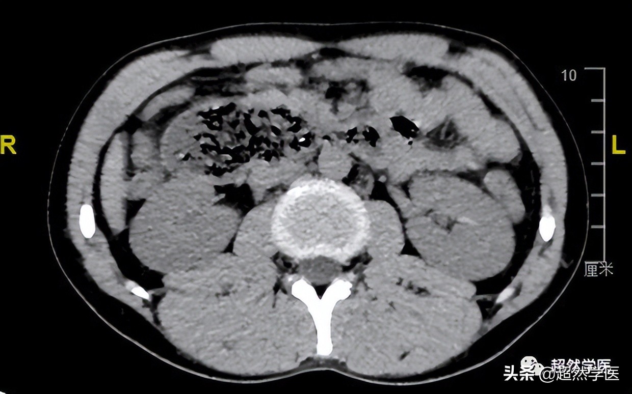 十二指肠球部狭窄导致呕吐,十二指肠降部隆起梗阻呕吐
