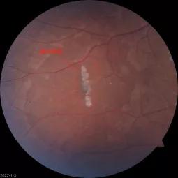 千万别和激光笔“对视”！13岁女孩只因看了一眼，眼底被灼伤