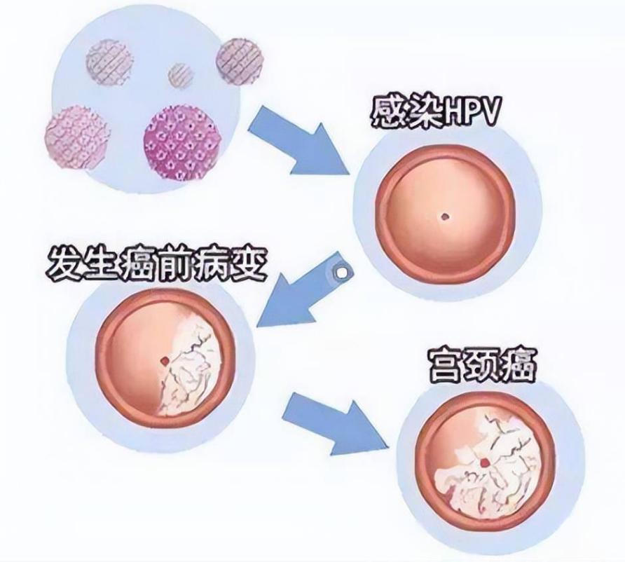 47岁还有必要做宫颈癌筛查吗,70以上还有必要做宫颈癌筛查吗