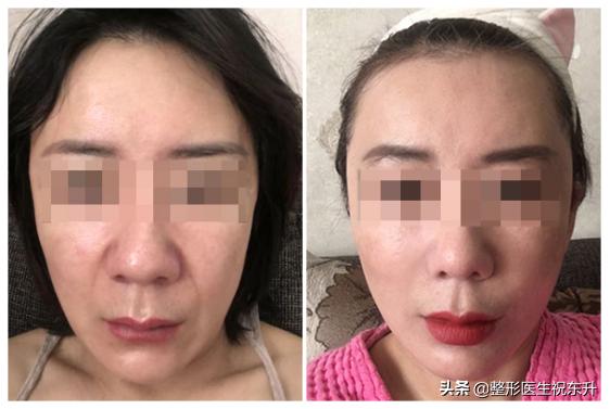 法令纹太深了怎么办？十有八九是这4种原因所致