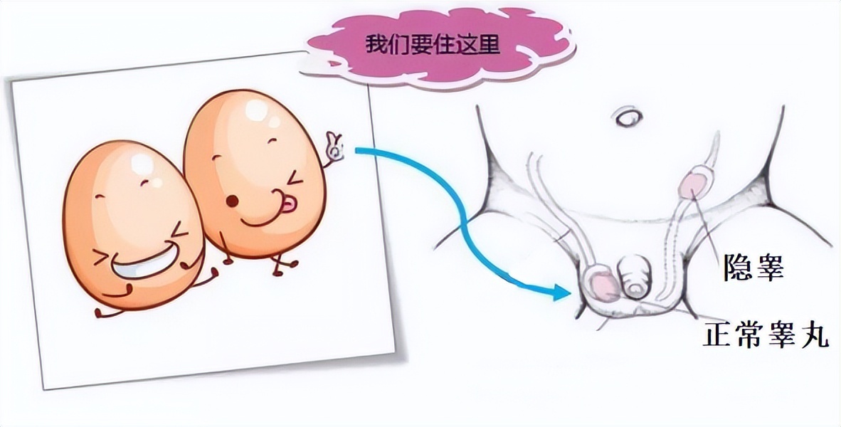 隐睾是先天性疾病吗能治好吗,什么引起男性隐睾