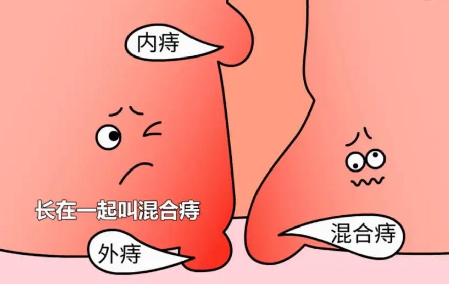 女孩痔疮手术恢复过程,女生痔疮手术的全部流程