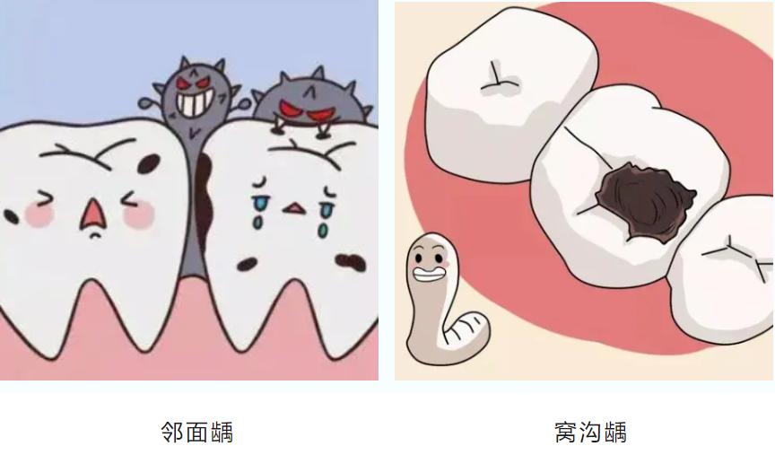 牙齿有蛀牙黑洞怎么办,我的牙齿有洞