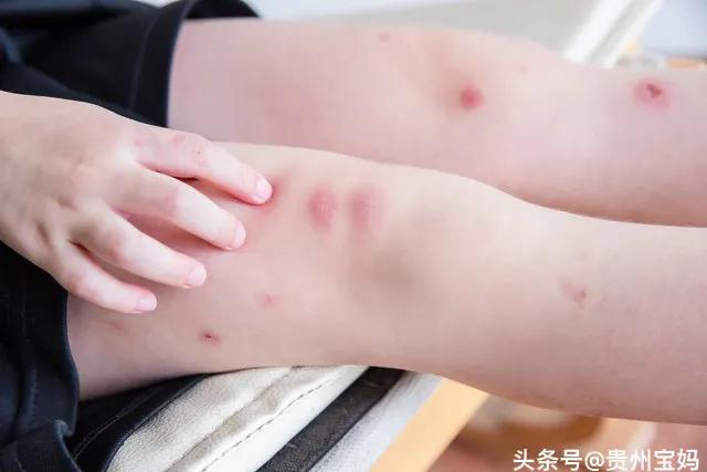 蚊子是怎么吸人类的血的,蚊子为什么要冒着生命危险吸人血