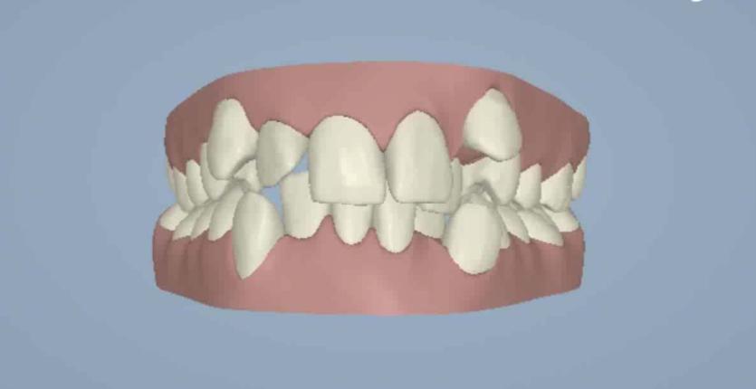 牙缝有牙结石怎么去除,牙缝间的牙结石怎么清除