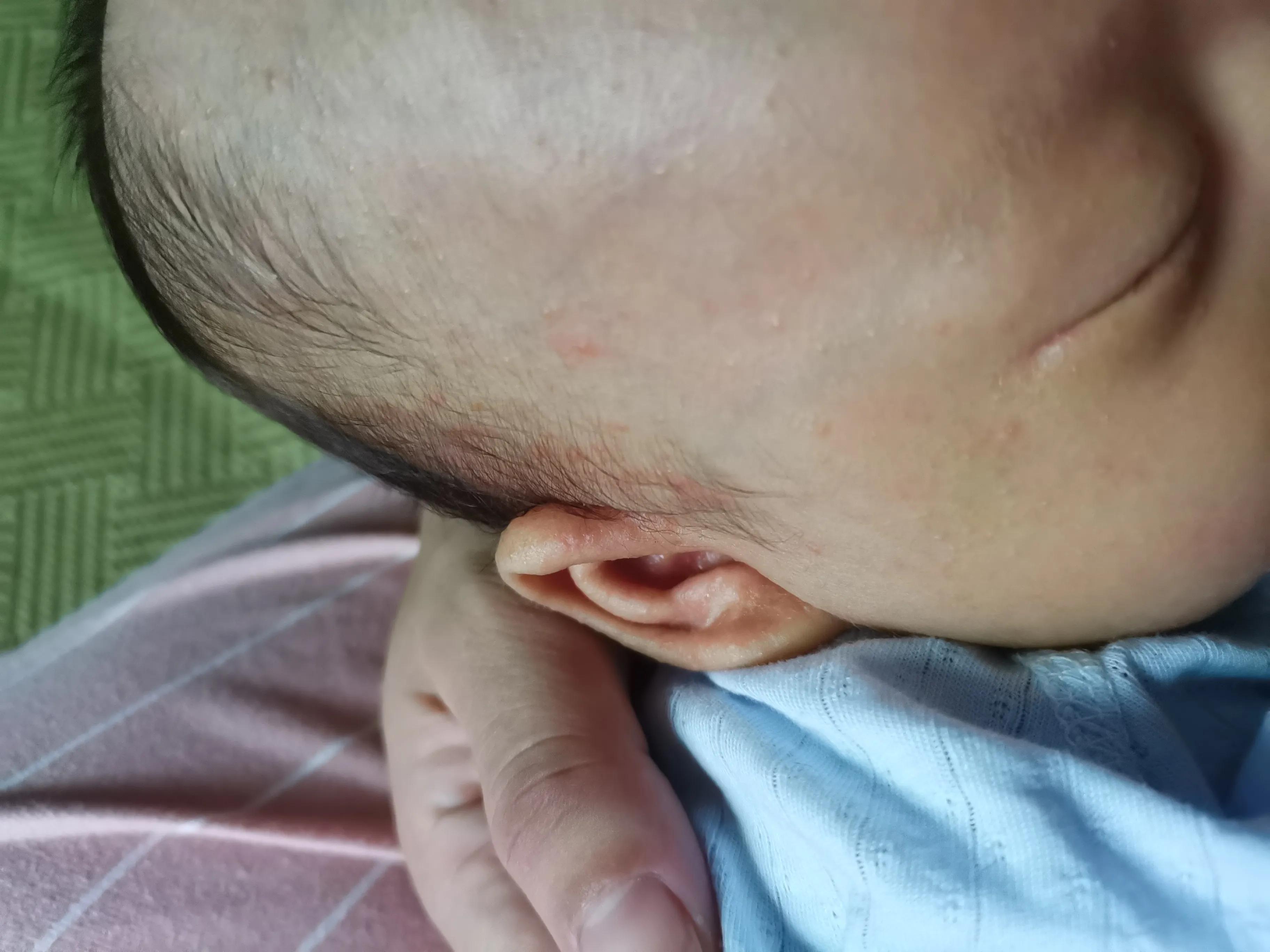 南方湿疹的最佳治疗方法,婴儿耳垂根部湿疹