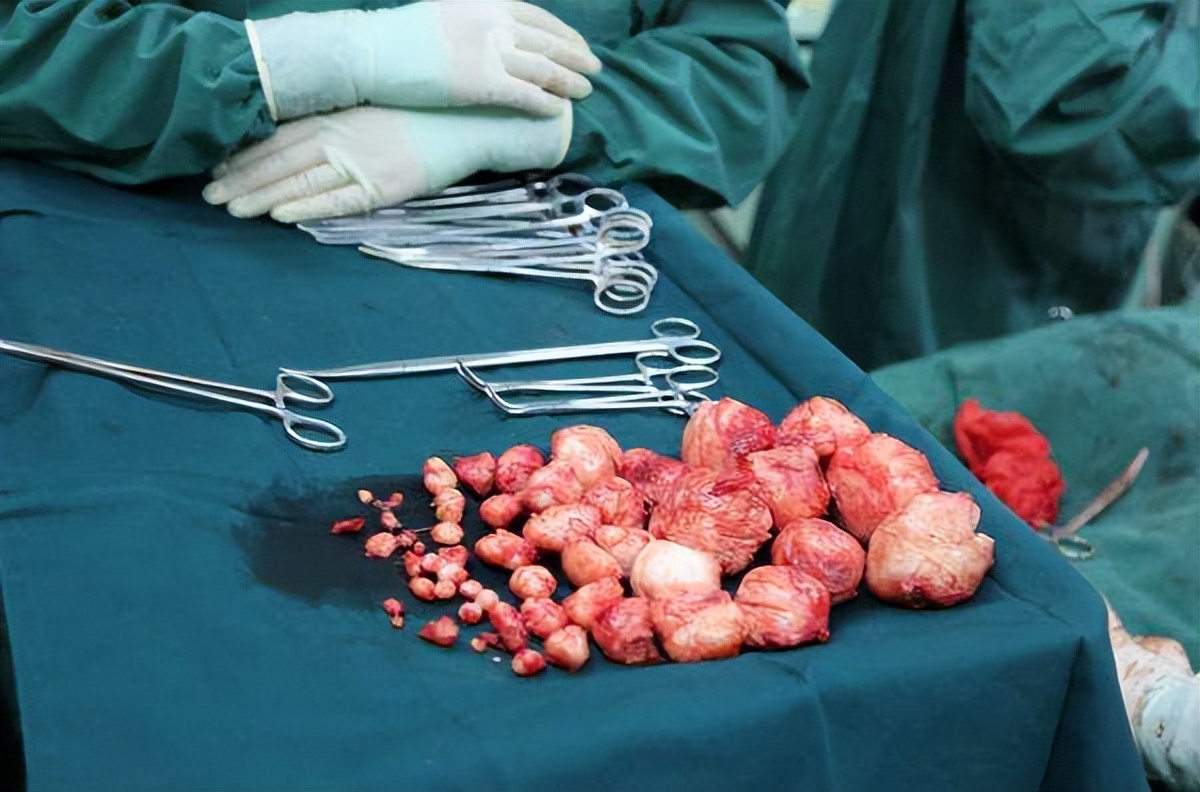 引起子宫肌瘤最常见的原因是,女性引发子宫肌瘤的原因