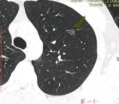 因癌症去世的妈妈,母亲肺癌子女查出磨玻璃结节