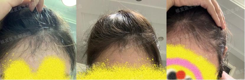 植发后后枕部的头发多久能恢复,植发3个月恢复图片
